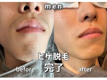 キュー(cue)/【メンズ】「ヒゲ脱毛」完了♪