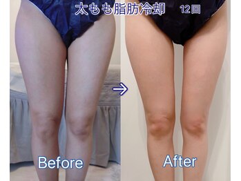 ルアナ(Luana)/夏までに痩せる!脂肪冷却痩身☆