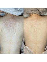 ジョンミー(JONMEE)/ハーブピーリングで背中ケア◎