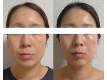 ユニ(Uni)/寝てるだけで　中顔面短縮