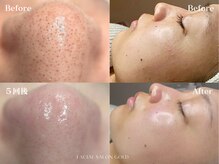【５回後】ツルピカお肌がやみつきになる毛穴洗浄○*゜。・