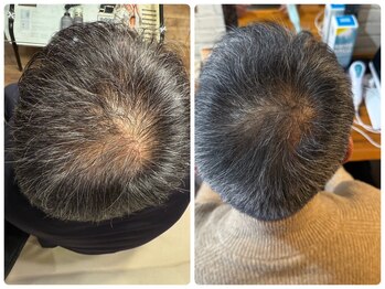 エミュ(emu)/水光頭皮　beforeafter写真