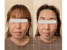 グロッシー(glossy)/小顔矯正