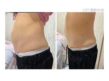 メディカルエステ 新宿南口店/*日本初-12℃脂肪冷却症例*