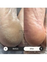 イチロクイチハチ(1618)/#臭い#カサつき#たこ#ひびわれ