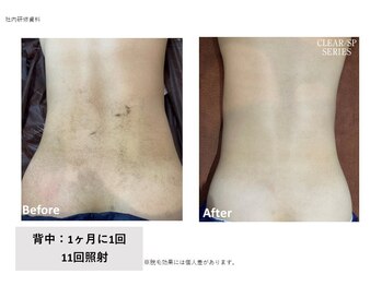 ヴィヴァーチェ(Vivace)/背中脱毛　Before→after