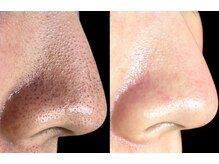 ディンプル(Dimple)/毛穴改善コース