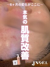 ジェノール 2nd beauty studio 姫路駅前店(JNOEL)/JNOEL肌質改善で魅せる肌に