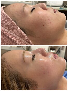 Ottimo Facial Salon/ニキビケア