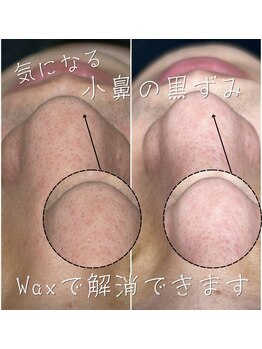 ジョエルワックス 沖縄糸満店(JOELLE WAX)/小鼻の黒ずみ気になりませんか？