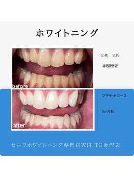 ホワイト 金沢店/プラチナコース週一通いのお客様