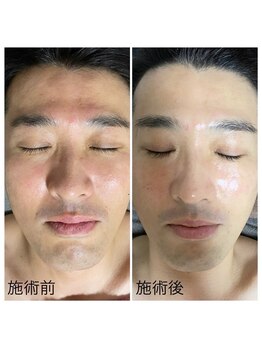 ゾーンビューティーハウス 松戸店(ZONE BEAUTY HOUSE)/メンズ肌ケアはお任せください。