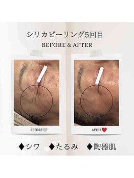 エクラ アン(eclat.un)/60代女性：シリカピーリング