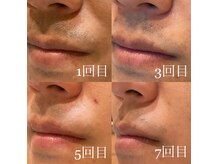 個室&痛みの少ない最新美肌脱毛で男性の方にも人気です。