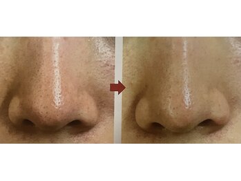 コルッソ(CoLusson.)/深層毛穴洗浄