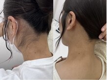 ミース 北九州店/うなじ◆ビフォーアフター