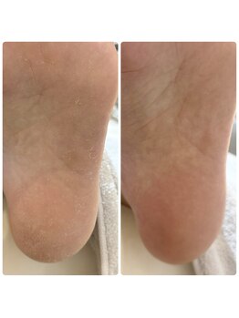 緒々 ワンプラス(one+)/ゴチゴチかかとになる前に！！