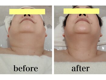 クリニカルエステ イーズ 泉北パンジョ店/40代～50代＃顎下の脂肪＃小顔
