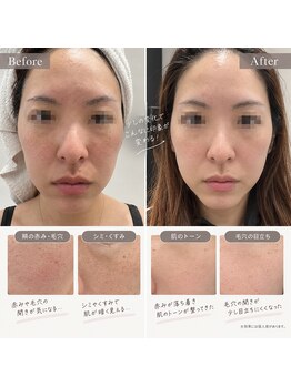 シェーン(schon)の写真/お肌のお悩みに本気で向き合いませんか?お悩み別メニューあり/導入美容/Wax脱毛/ツヤ肌育成/ピーリング
