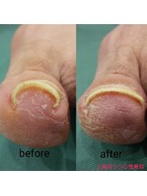 上高田つつじ整体院/巻き爪　ネイルケア　例