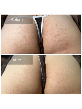 アーユルヴェーダアンドアロマエステ アユス(AYUS)/ハーブピーリングお尻