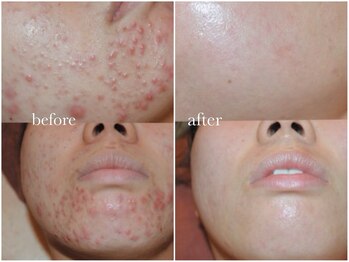 クク(ququ)/ニキビケアに