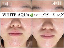 ホワイトアクア 梅田本店(WHITE AQUA)/ハーブピーリングで顎ニキビケア