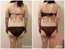 リリィブラン(Lily branc)/【痩身】上半身/背中+ウエスト腰