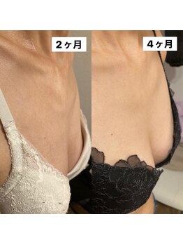 ララルアナ(Lara luana)/バストアップ、バストケア