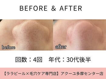 ア クーユ 多摩センター店/毛穴洗浄/毛穴の黒ずみ/肌管理