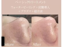 エヌフェイシャル(N.facial)の雰囲気（ピーリングは、水素水＋美容液＋ヒアルロン酸130倍高保湿を導入）