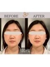 チョコバリ 錦糸町店(chocobari)/小顔×リフトアップ(美容鍼)20代