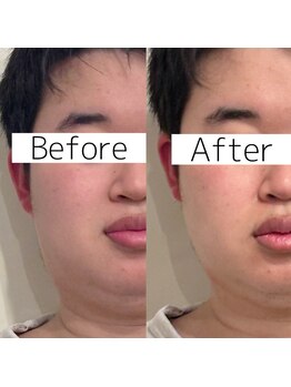 シーズボーテ(C's Beaute)/速効★小顔ケア