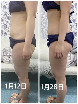 ハロ 南青山(HALO)/全身キャビテーション+ラジオ波