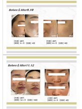 リグ 郡山店(LIG)/光フェイシャル