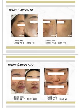 リグ 郡山店(LIG)/光フェイシャル