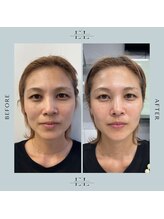 ラプティット(La petite)/30代女性/1回の変化