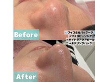 エン クリニカルラボ(E&N CLINICAL LABO)の雰囲気（ハイドラ毛穴洗浄-ピーリングで毛穴レスなお肌へ♪ワイコ/ハーブ）