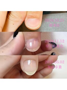 ロータス(LOTUS)/自爪育成卒業までの道のり