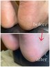 【footベーシックケア】足裏角質ケア☆