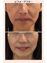 リファイン(REFINE)/徹底たるみ改善★アルジルリン