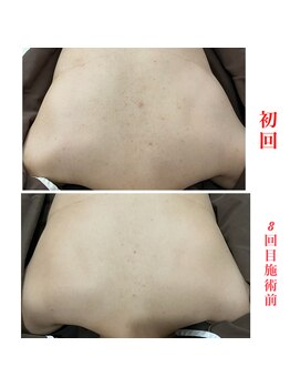 ライフ美容整体院 恵比寿(Life美容整体院)/背中ハーブピーリング