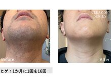 ドルチェビューティーサロン 戸塚安行店(Dolce Beauty Salon)/髭脱毛16回（男性）