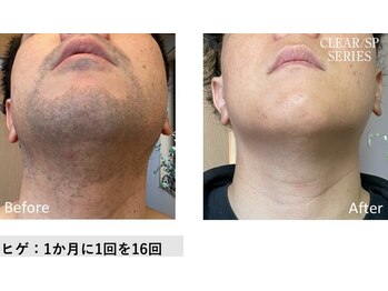 ドルチェビューティーサロン 戸塚安行店(Dolce Beauty Salon)/髭脱毛16回（男性）