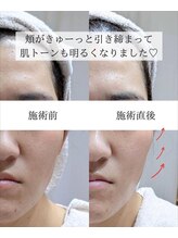 ハジュ(HAJU.)/フォト光フェイシャル