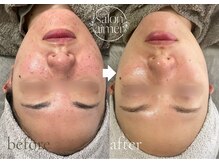 サロンエメ(salon aimer)の雰囲気（クリスティーナのピーリングでリバウンドしない肌作り！岡山市）