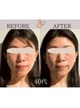 チョコバリ 錦糸町店(chocobari)/小顔×リフトアップ(美容鍼)40代