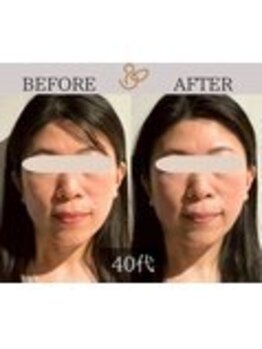 チョコバリ 錦糸町店(chocobari)/小顔×リフトアップ(美容鍼)40代