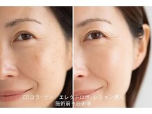 憩いサロン ユリ(yuri)/COエレクトロポーレション導入