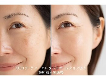 憩いサロン ユリ(yuri)/COエレクトロポーレション導入